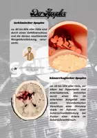 Vorschau - Poster - One Minute Wonder zu den Ursachen eines Schlaganfalles - Seite 2
