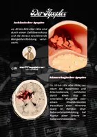 Vorschau - Poster - One Minute Wonder zu den Ursachen eines Schlaganfalles - Deckblatt