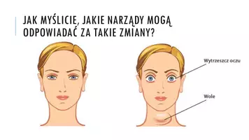 zapowiedź - Prezentacja - Nadczynność i niedoczynność gruczołów dokrewnych - strona 1