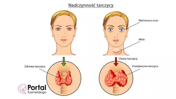 zapowiedź - Prezentacja - Nadczynność i niedoczynność gruczołów dokrewnych - strona 2